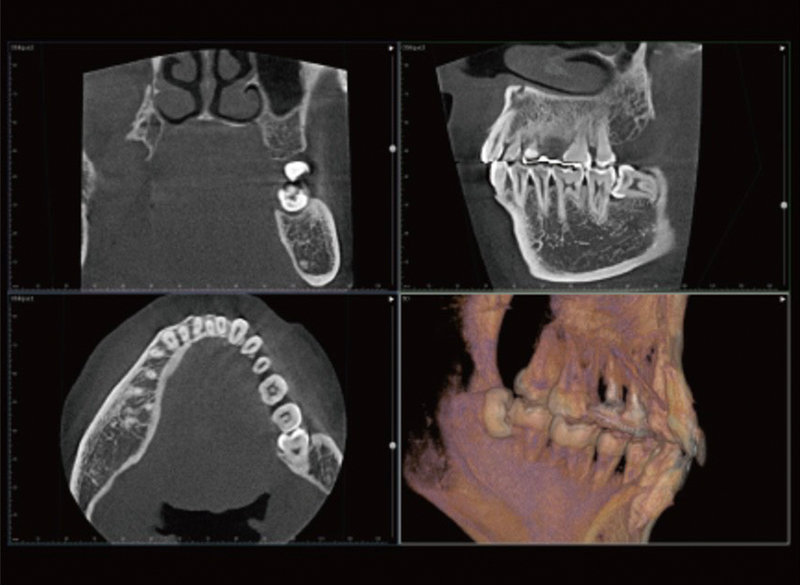 歯科用CT